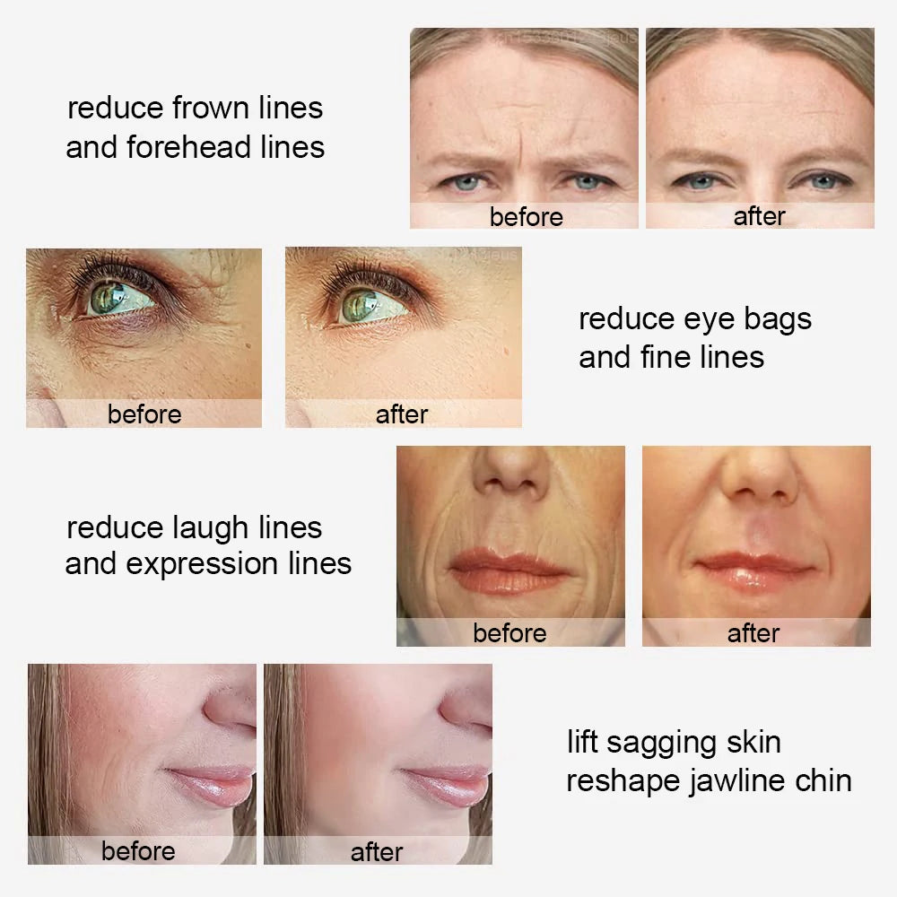 Masseur Facial RF EMS - Radiofréquence & Microcourant Lifting - badassmood